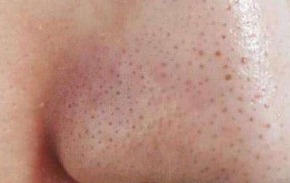 清潔面膜哪個牌子可以快速祛黑頭？趙薇、薇婭 推薦的紐西之謎泥膜真的好用嗎？